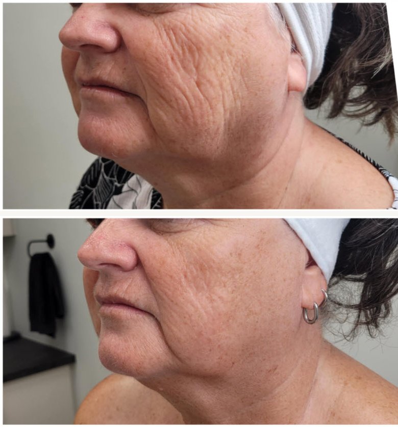 Avant et après une cure de rajeunissement par laser : bas du visage et ligne de la mâchoire d'une cliente de la clinique